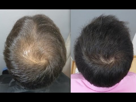 crown clinic hair transplant reviews