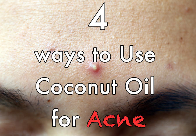 coconut oil for acne reviews