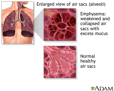 the american review of respiratory disease